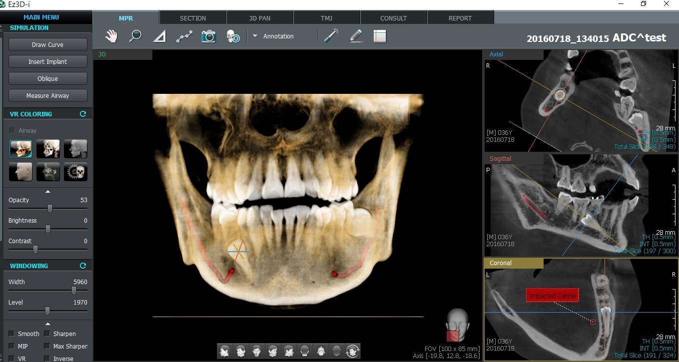 cone beam 3d vatech