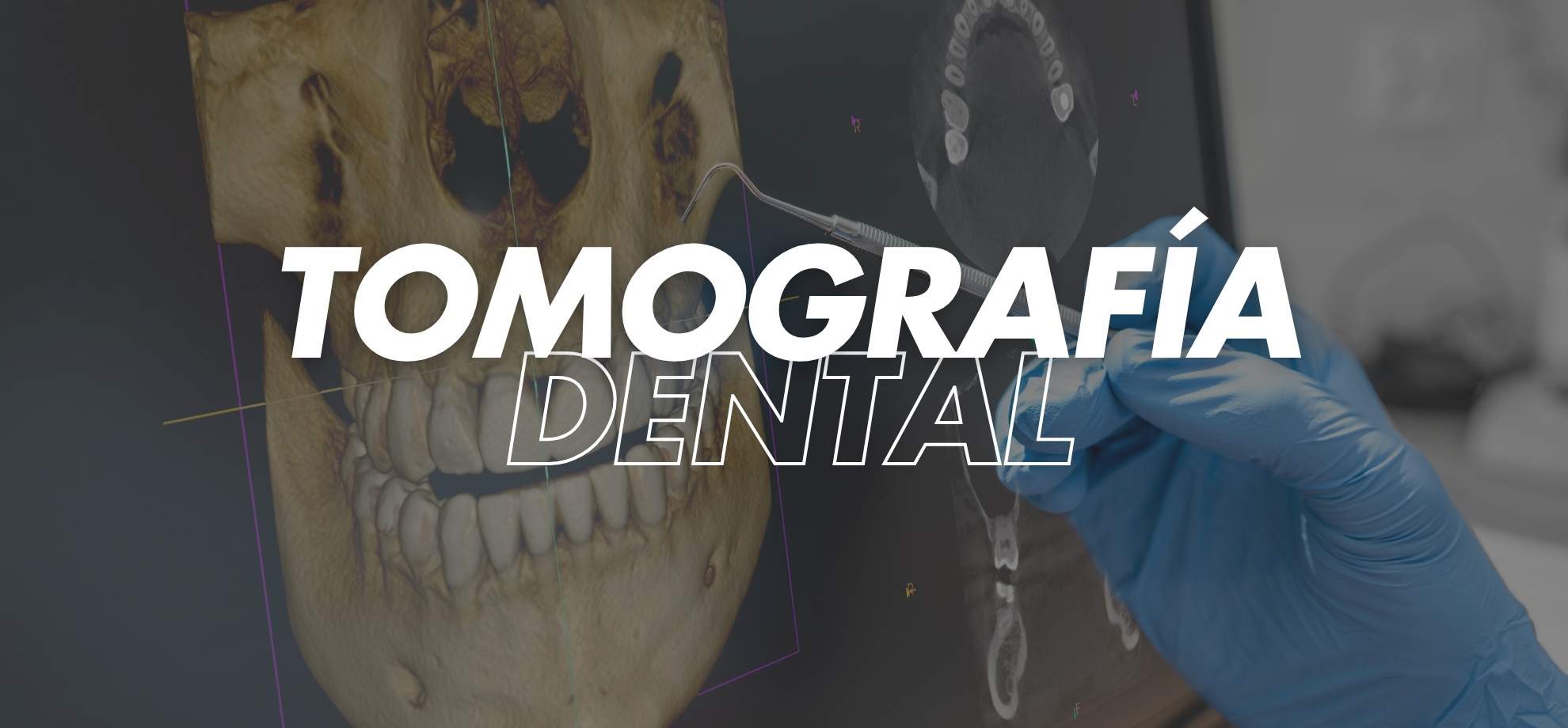 tomografía dental