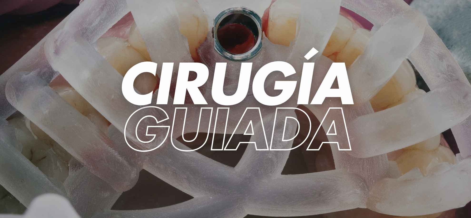 ¿Qué es la cirugía guiada para implantes dentales y cómo beneficia a los pacientes? 3 cirugía guiada